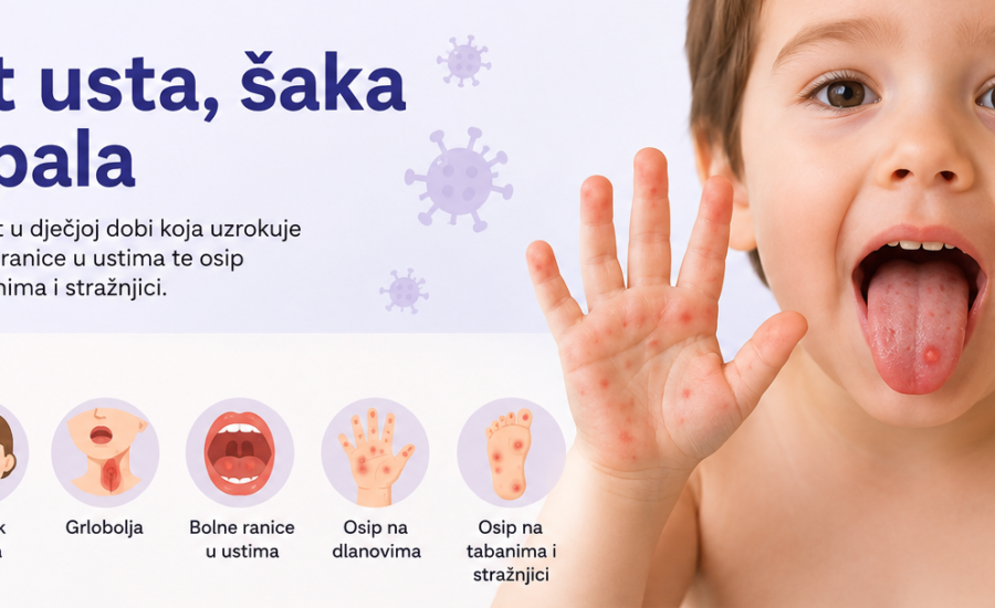 Bolest usta, šaka i stopala: simptomi, liječenje i prevencija